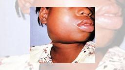 Harare City Issues Mumps (Mahumunya) Alert